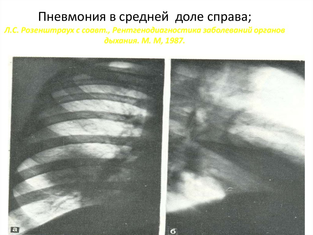 Пневмония в средней доле справа; Л.С. Розенштраух с соавт., Рентгенодиагностика заболеваний органов дыхания. М. М, 1987.