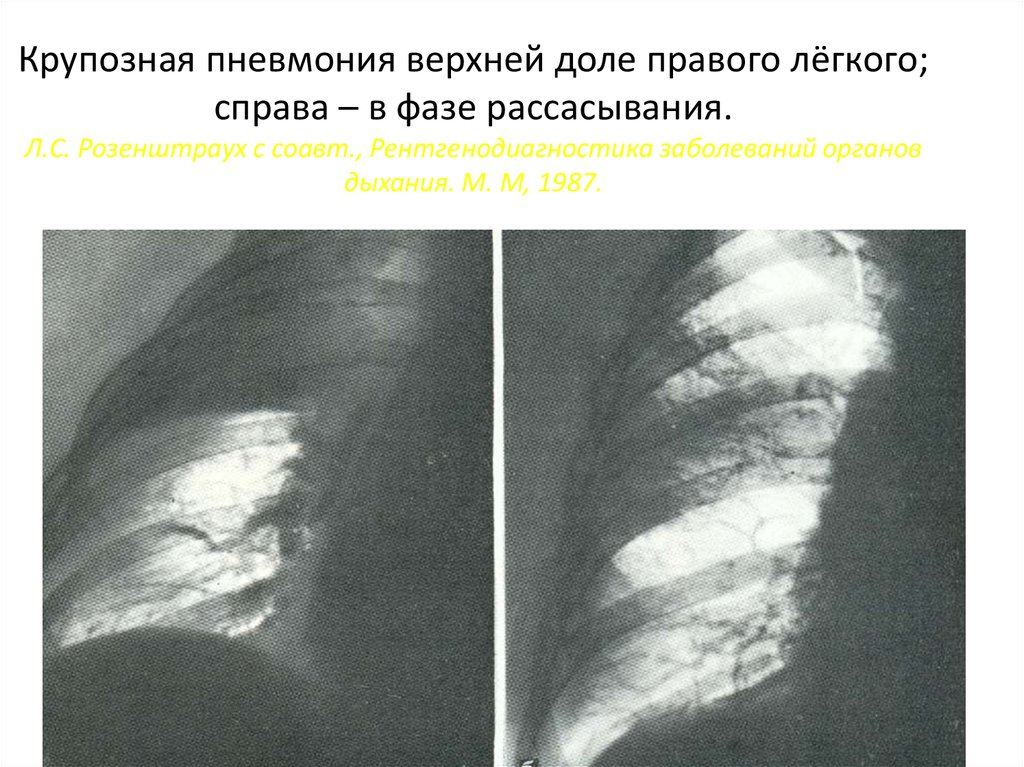 Крупозная пневмония верхней доле правого лёгкого; справа – в фазе рассасывания. Л.С. Розенштраух с соавт., Рентгенодиагностика