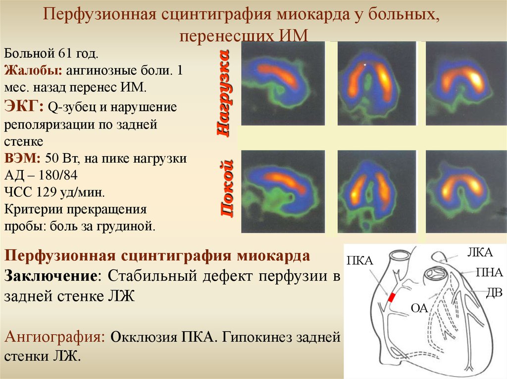 Презентация сцинтиграфия миокарда