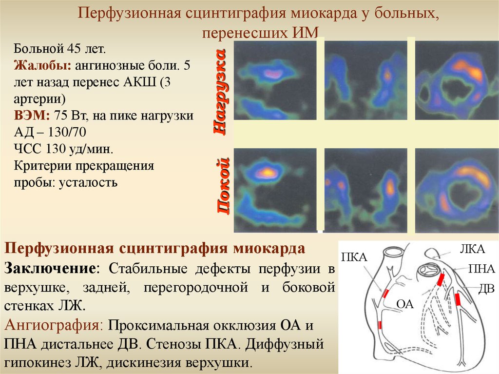 Презентация сцинтиграфия миокарда