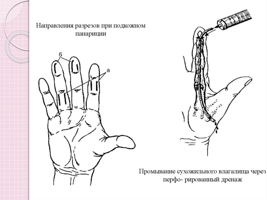 Обезболивания при оперативном лечении панарициев и флегмон