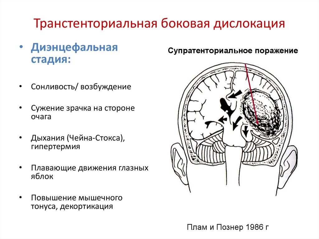 Признаки дислокации