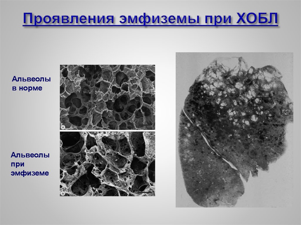 Легкие при хобл картинки