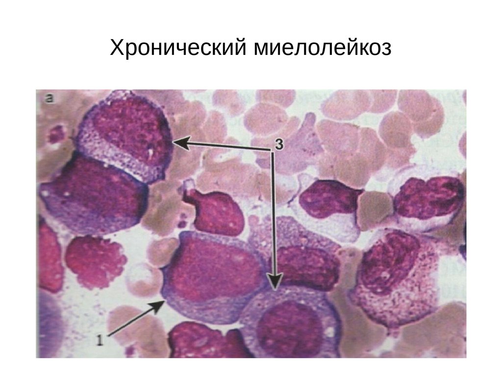 Хронический миелолейкоз. Острый миелобластный лейкоз лабораторные. Хронический миелолейкоз лейкоз. Гистология хронического миелолейкоза. Миелоцитарный хронический лейкоз (миелолейкоз)..