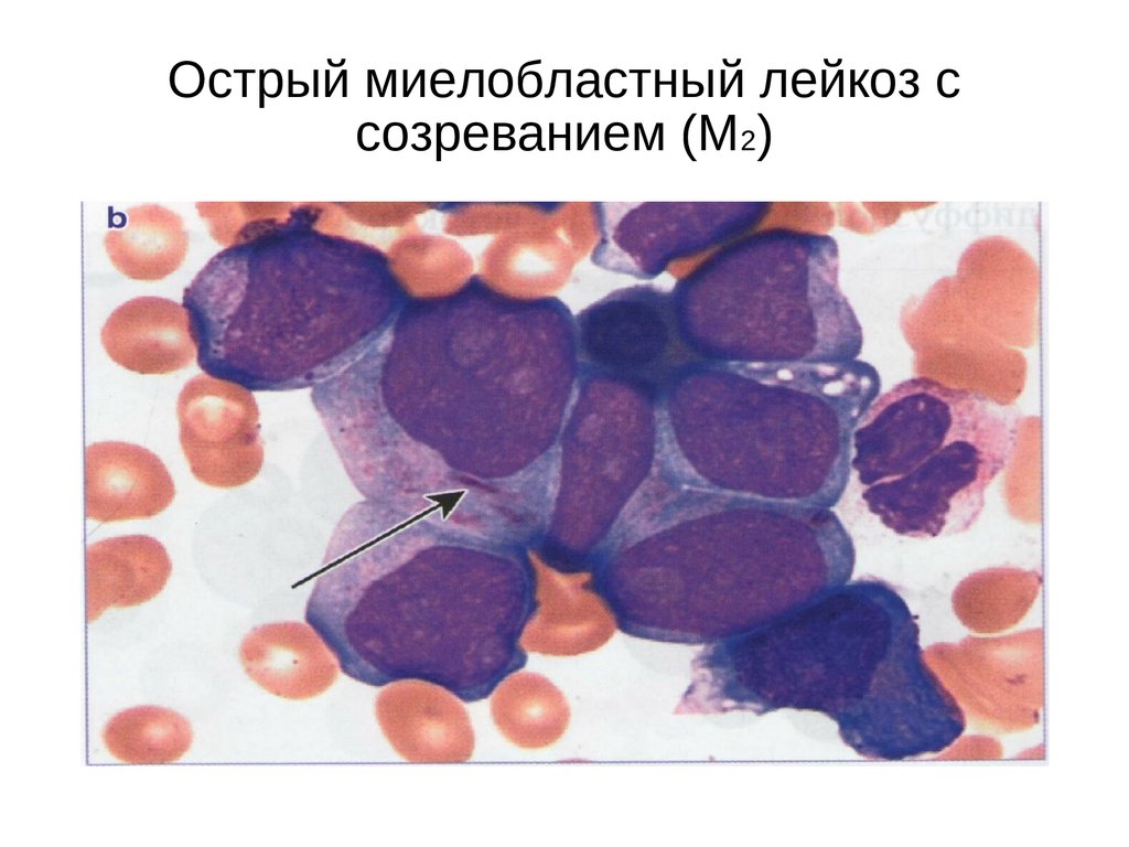 Лечение миелобластного лейкоза. Острый миелобластный лейкоз м2. Острый миелобластный лейкоз лабораторная диагностика. Острый миелобластный лейкоз патанатомия. ОМЛ острый миелолейкоз.