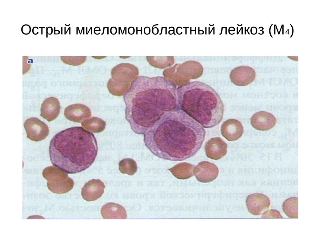 Недифференцированный лейкоз. Острый монобластный (миеломонобластный) лейкоз. Острый миелобластный лейкоз м4. Острый миеломоноцитарный лейкоз. Острый миелобластный лейкоз картина крови.