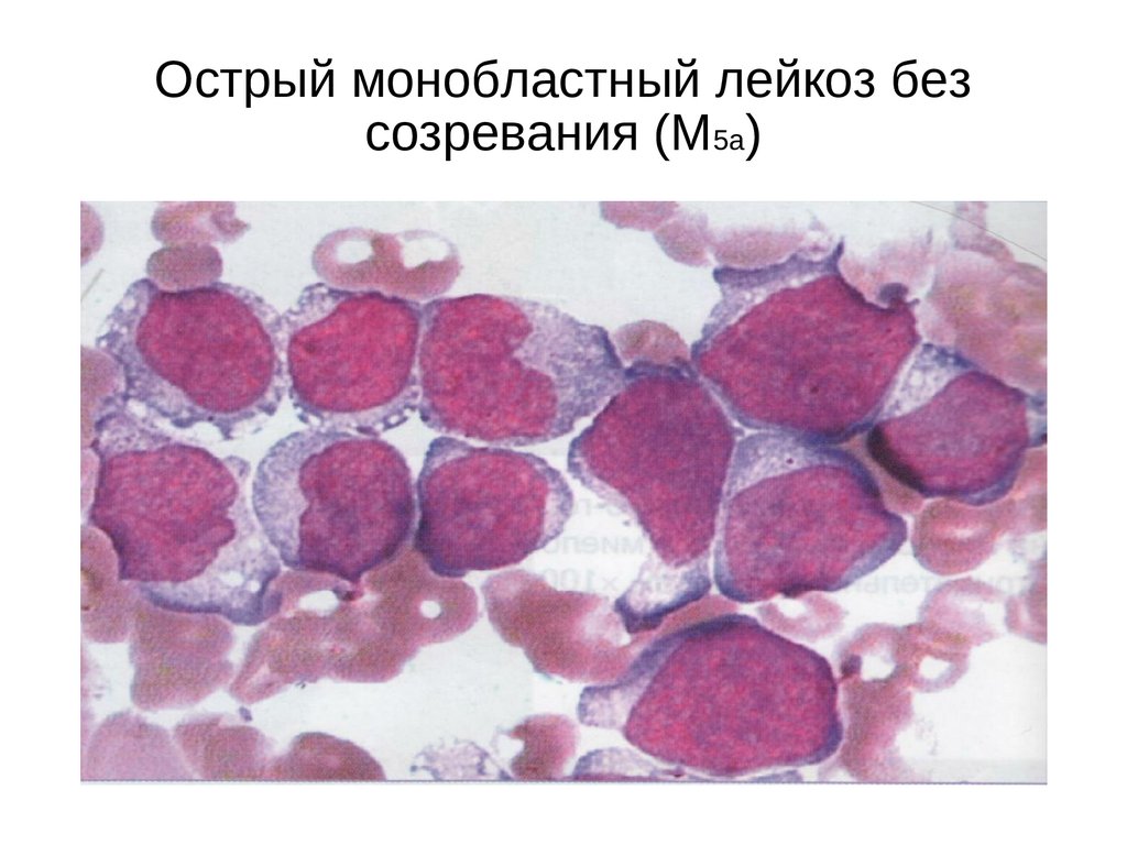 Хронический моноцитарный лейкоз. Острый лимфобластный лейкоз гистология. Острый монобластный лейкоз. Картина крови. Острый моноцитарный лейкоз картина крови. Острый миелобластный лейкоз картина крови.