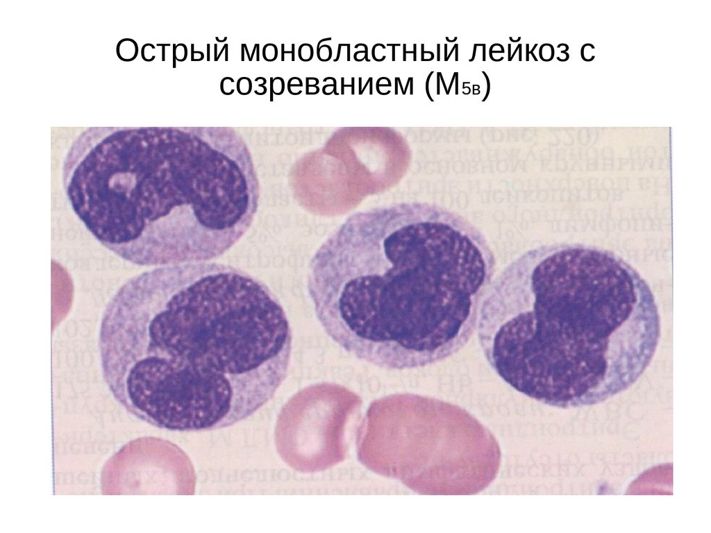 Картина лейкоза. Острый моноцитарный лейкоз. Острый монобластный лейкоз мазок. Острый монобластный лейкоз гистология. Острый миелобластный моноцитарный лейкоз.