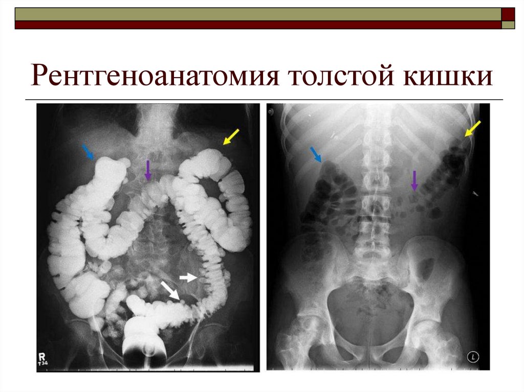 Ирригоскопия почек. Ирригоскопия Толстого кишечника рентген. Рентген контрастирование кишечника. Инвагинация Толстого кишечника рентген. Ирригография непроходимость.