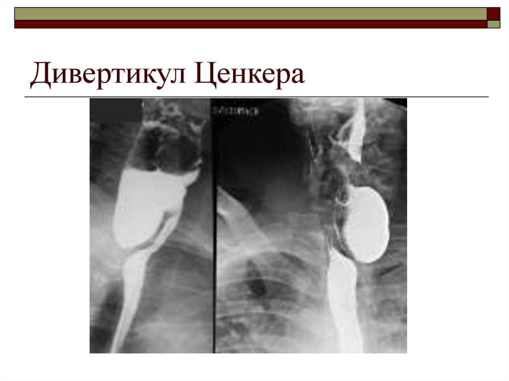 Диагностика дивертикула пищевода