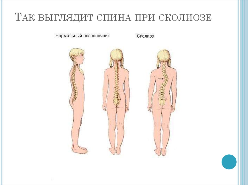 Сколиоз картинки для презентации