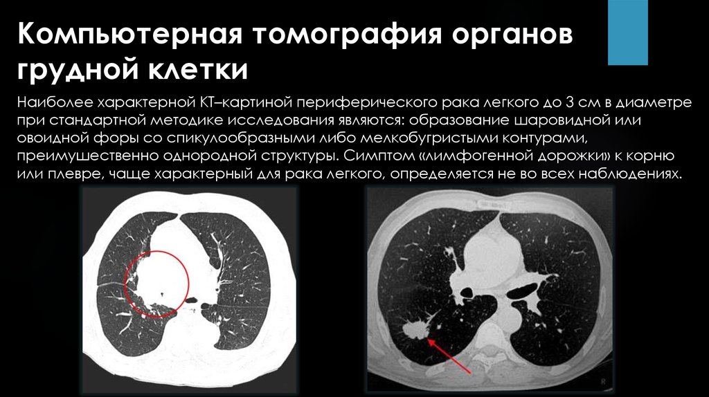 На кт виден рак. Кт легких. Компьютерная томография (кт) легких. Компьютерная томография органов грудной клетки. Нормальное кт легких.