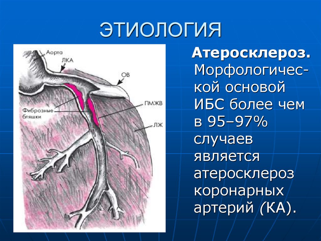 Атеросклероз аорты и коронарных артерий. ИБС атеросклероз аорты. Аорта и коронарные артерии. Этиология атеросклероза коронарных артерий.