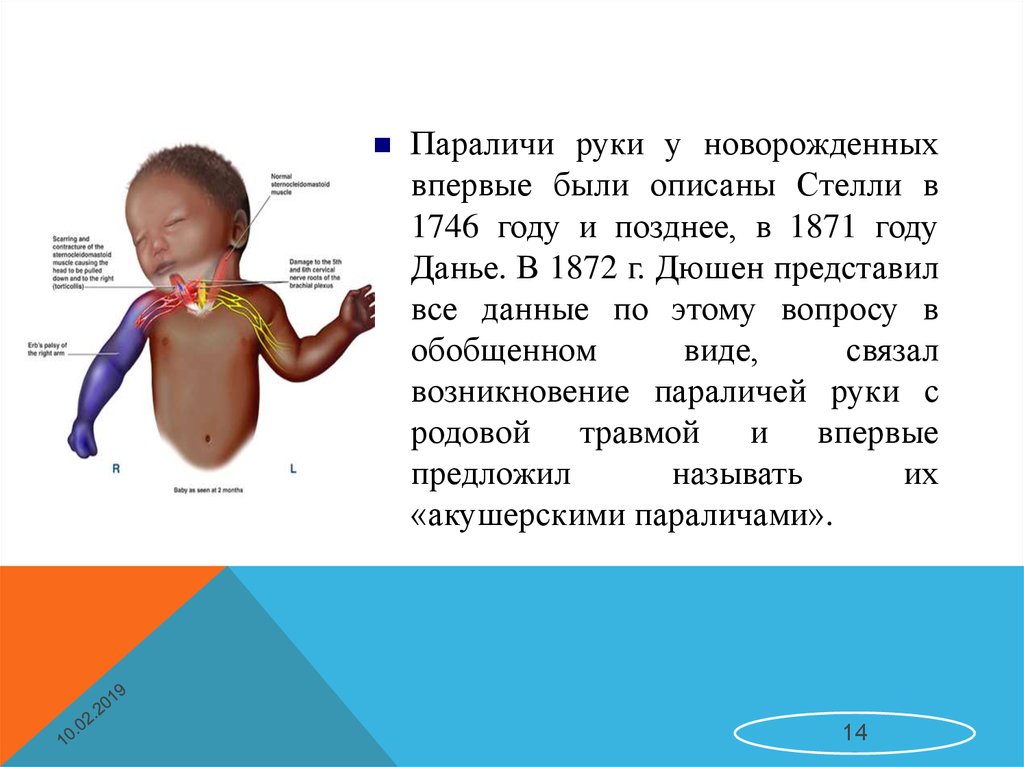 Парез руки. Парезы рук у новорожденных. Периферическая система новорожденного.