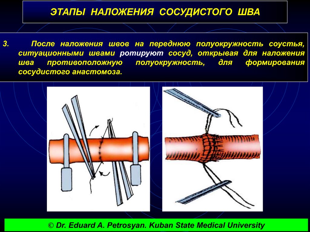 Бесшовное соединение сосудов метод а г коневского. Наложение сосудистого шва. Сосудистые швы техника наложения.