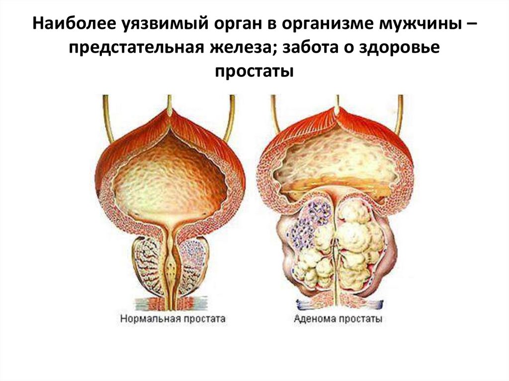 Наиболее уязвимый орган в организме мужчины – предстательная железа; забота о здоровье простаты