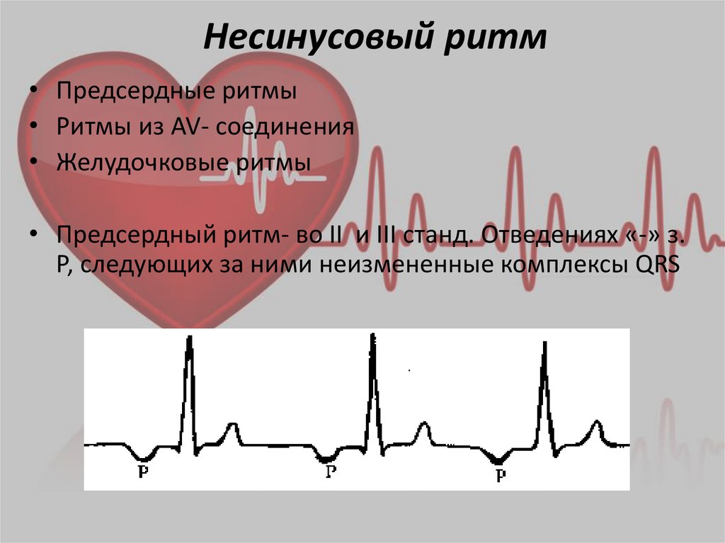 Экг синусовый ритм что это. Ритм синусовый и несинусовый. Синусовый ритм и несинусовый ритм. Ритмы сердца синусовый и несинусовый. Несинусовый ритм сердца на ЭКГ.