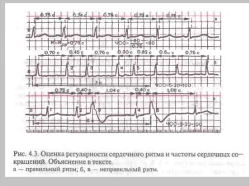 Определение источника возбуждения водителя ритма экг