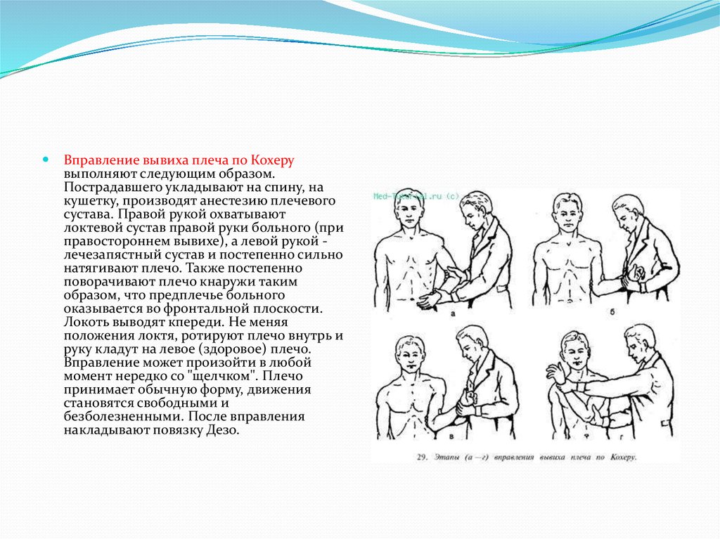 Вывих плеча презентация