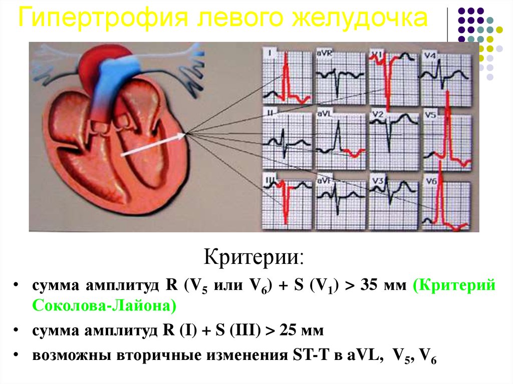 Причины гипертрофии левого желудочка. Гипертрофия отделов сердца. Гипертрофия левых отделов сердца на ЭКГ. Гипертрофия правого желудочка на ЭКГ. Гипертрофия левого желудочка сердца на ЭКГ.