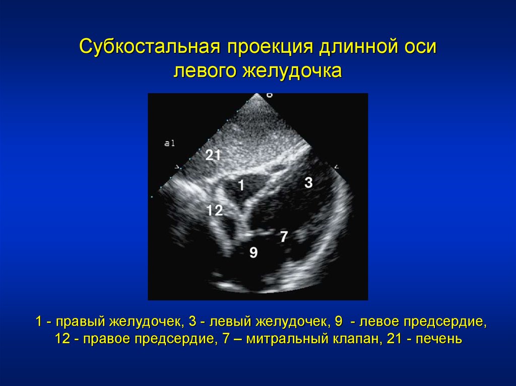 Стенки правого желудочка