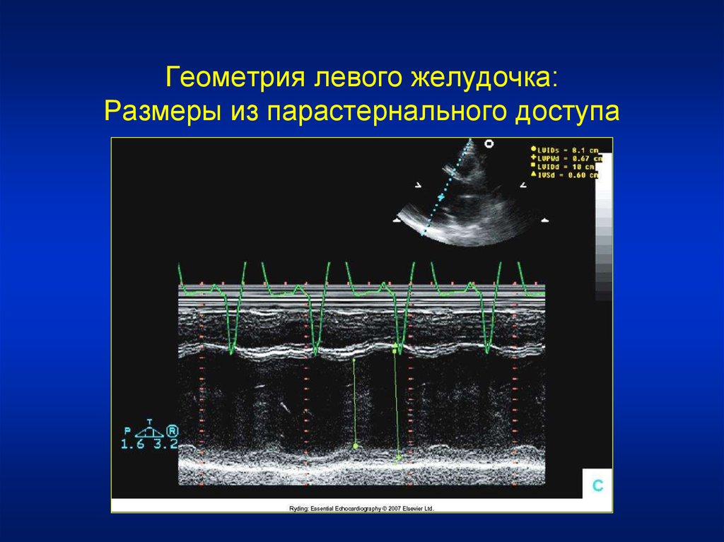 Эхо левого желудочка. Парастернальная позиция короткая ось аортального клапана. Парастернальная позиция по длинной оси левого желудочка. Парастернальная позиция в ЭХОКГ. УЗИ сердца парастернальная позиция.