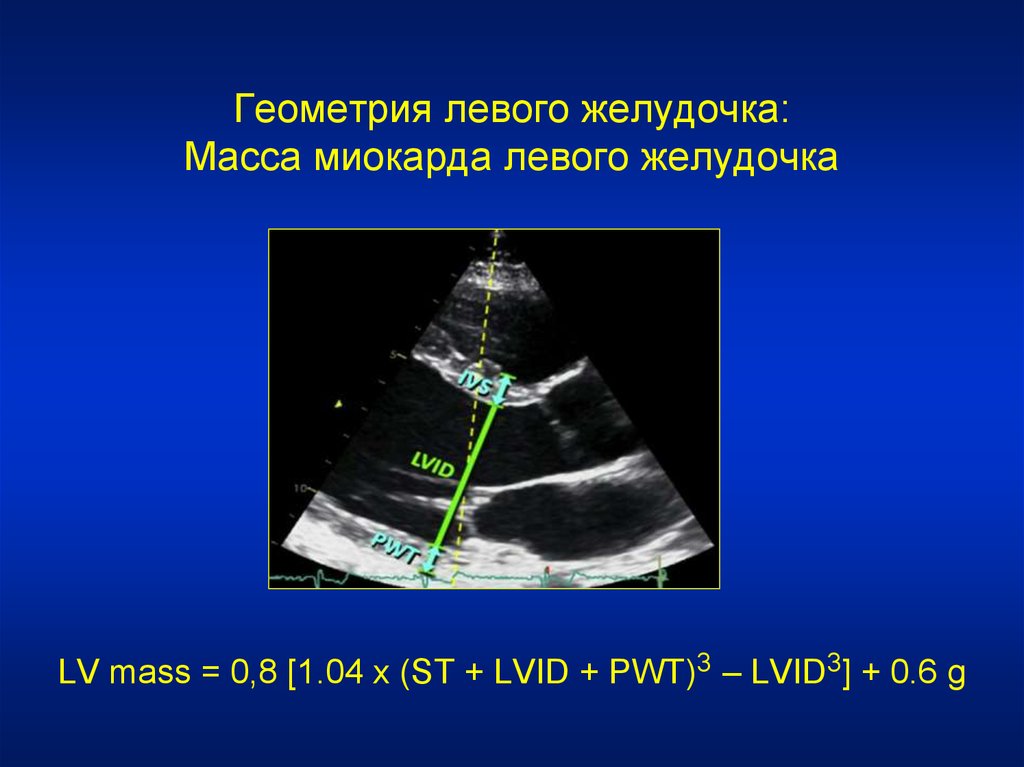 Масса левого желудочка. Масса миокарда левого желудочка.