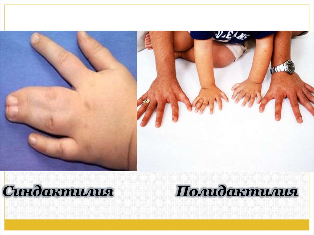 Синдактилия Полидактилия