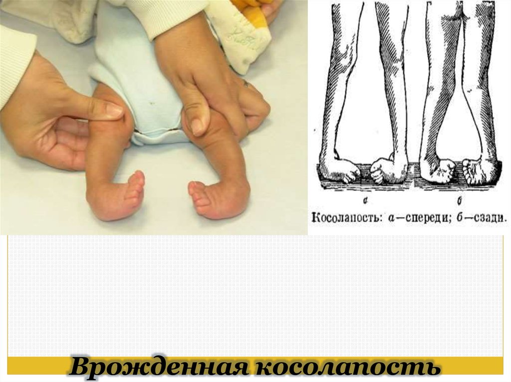 Врожденная косолапость