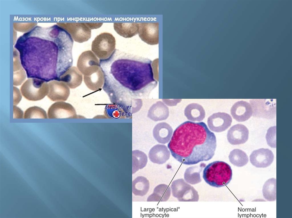 Атипичные мононуклеары картинки