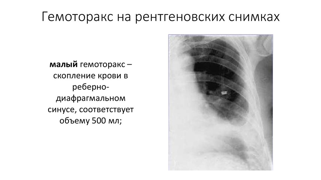 Лучевые признаки гидроторакса гемоторакса рентгеновская картина