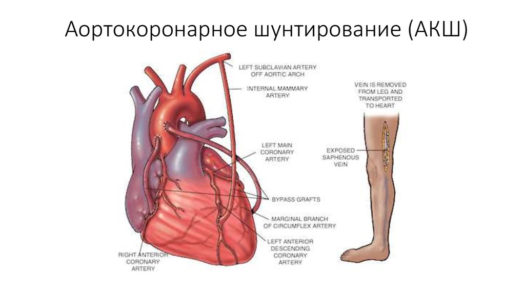 Схема аортокоронарного шунтирования