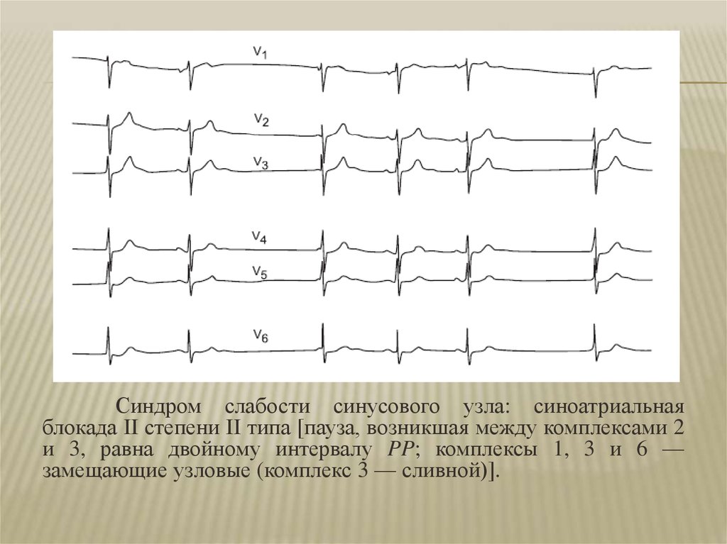 Сссу в кардиологии. Синдром слабого синусового узла ЭКГ. Синдром слабости синоатриального узла ЭКГ. Синдром синусового узла на ЭКГ. Синоатриальная блокада 3 степени ЭКГ ритм.