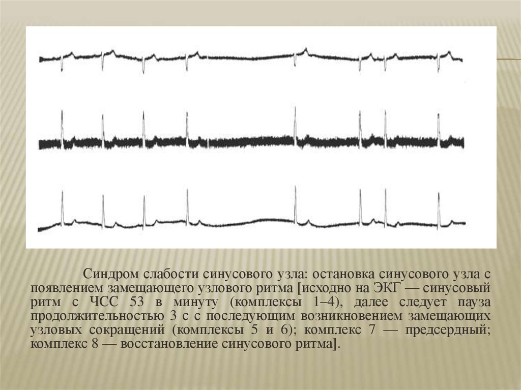 Что значит синусовый ритм сердца на экг. Синусовая пауза на ЭКГ. Паузы ЭКГ синусовый ритм. Слабость синусового узла на ЭКГ. Постэкстрасистолическая депрессия синусового узла на ЭКГ.