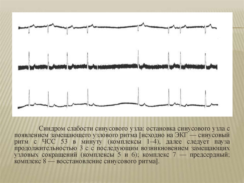 Синдром слабости синусового узла карта вызова смп