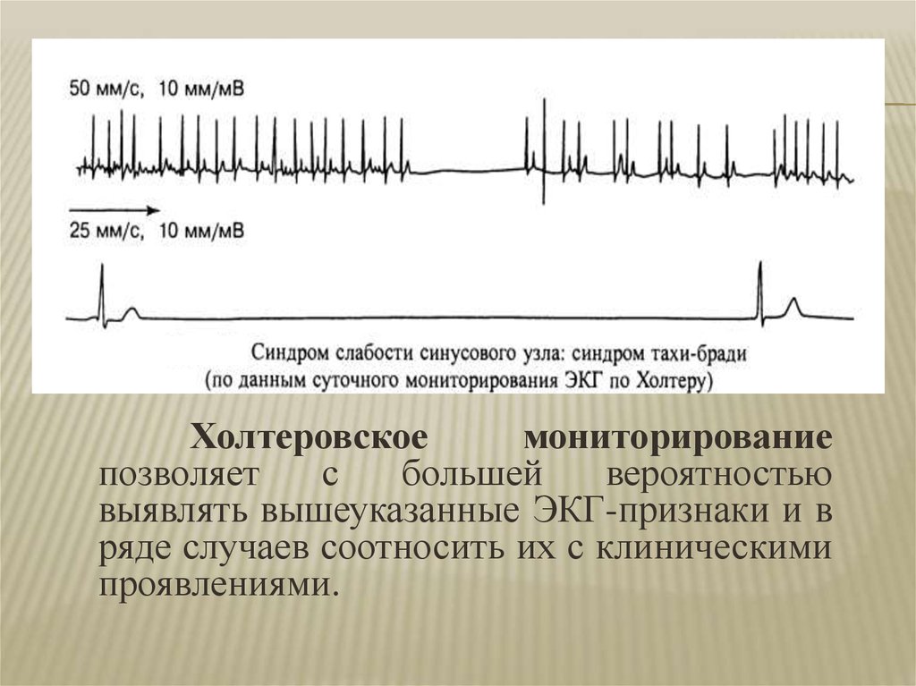 Синдром слабости синусового узла карта вызова смп