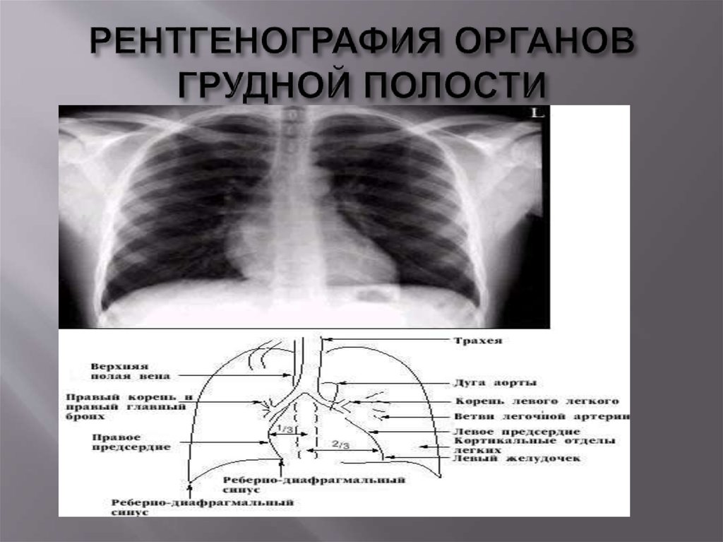 Описание рентгеновского снимка. Рентгенография органов грудной полости. Рентгенограмма органов грудной полост. Рентгеновские снимки грудной полости. Рентгенограммы органов грудной полости с описанием.