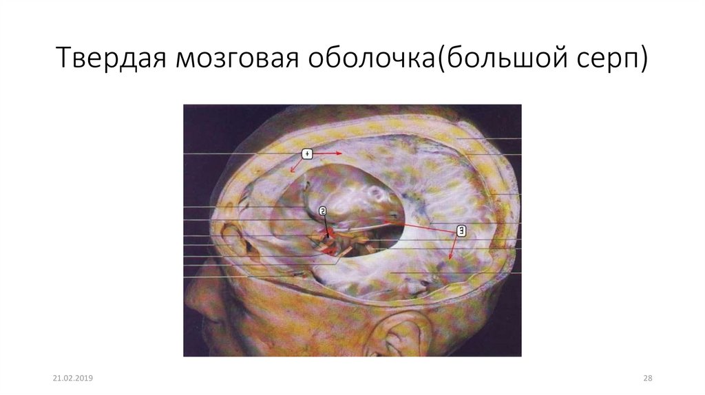 Твердый мозг. ТМО твердая мозговая оболочка. Серп большого мозга (твердая оболочка головного мозга). Прикрепление твердой мозговой оболочки. Твердая мозговая оболочка крепится.