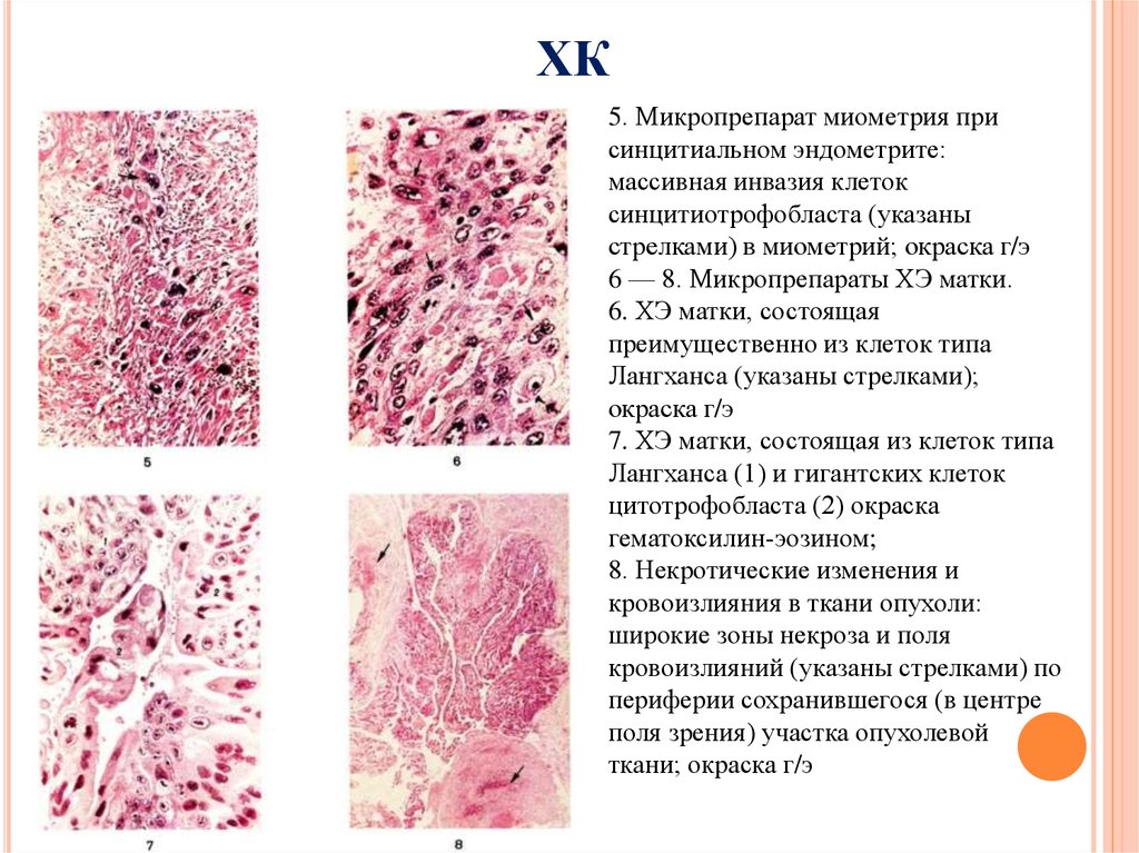 Септический эндометрит. Хориоэпителиома маткимикропрепарат. Септический эндометрит макропрепарат. Септический эндометрит микропрепарат. Синцитиальный эндометрит гистология.