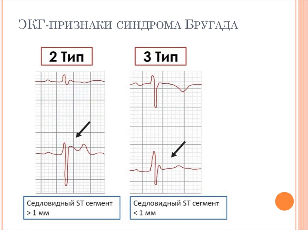 Синдром бругада на экг фото