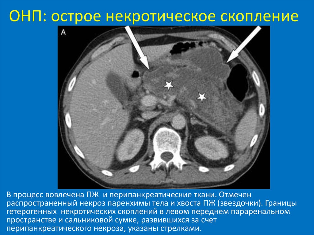 Кт картина острого панкреатита