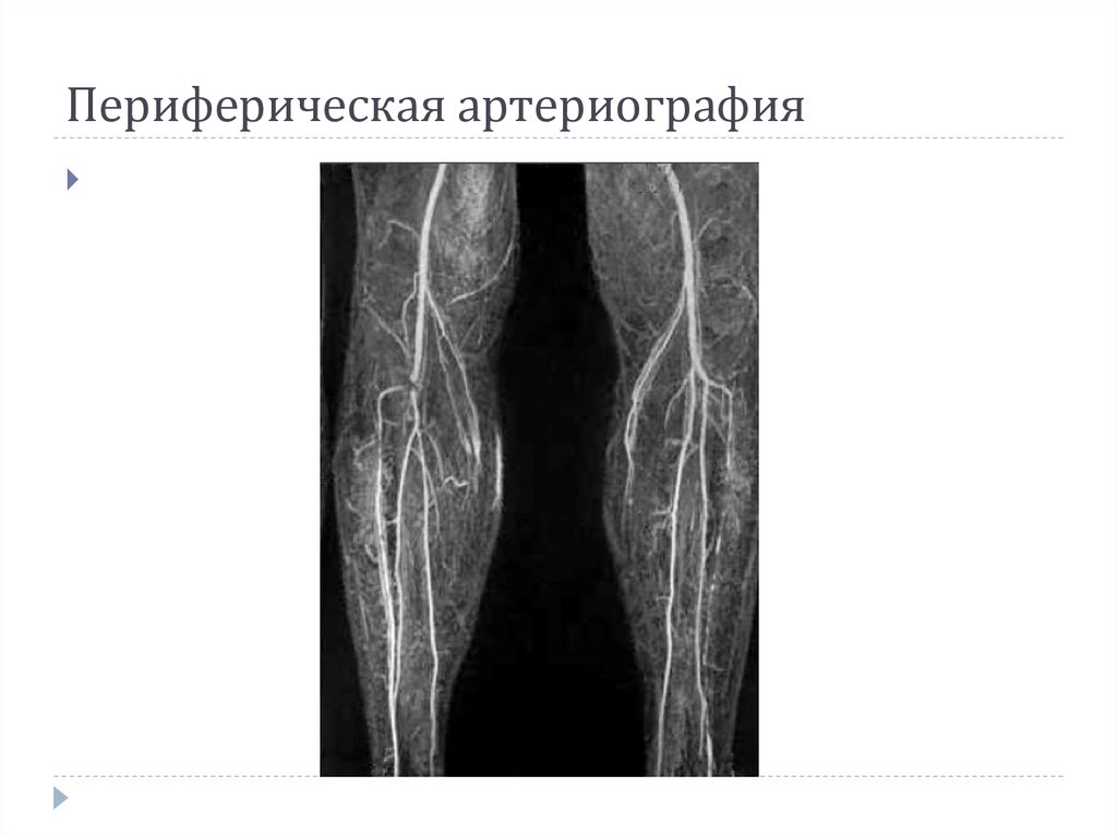 Флебография вен нижних. Периферическая артериография. Арторограытя. Артериография нижних конечностей. Цифровая субтракционная ангиография.