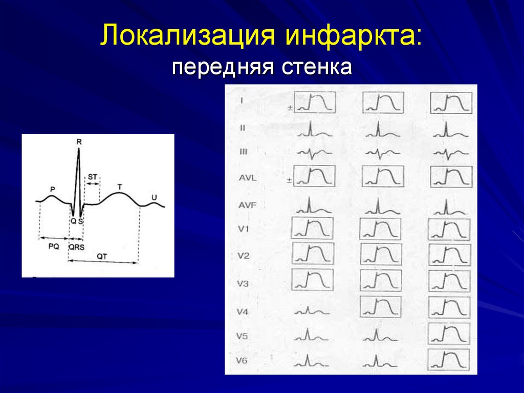 Инфаркт миокарда стенки. Инфаркт передней стенки отведения. Локализация стенок на ЭКГ. Локализация инфаркта. Локализация стенки инфаркта.