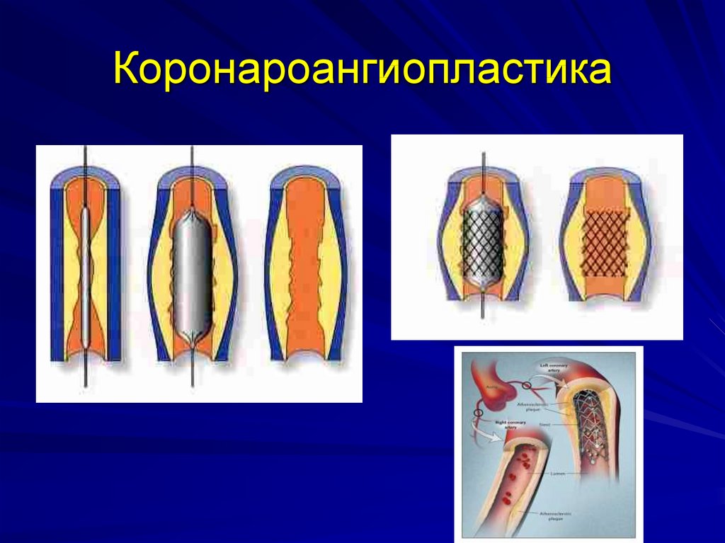 Транслюминальная хирургия презентация