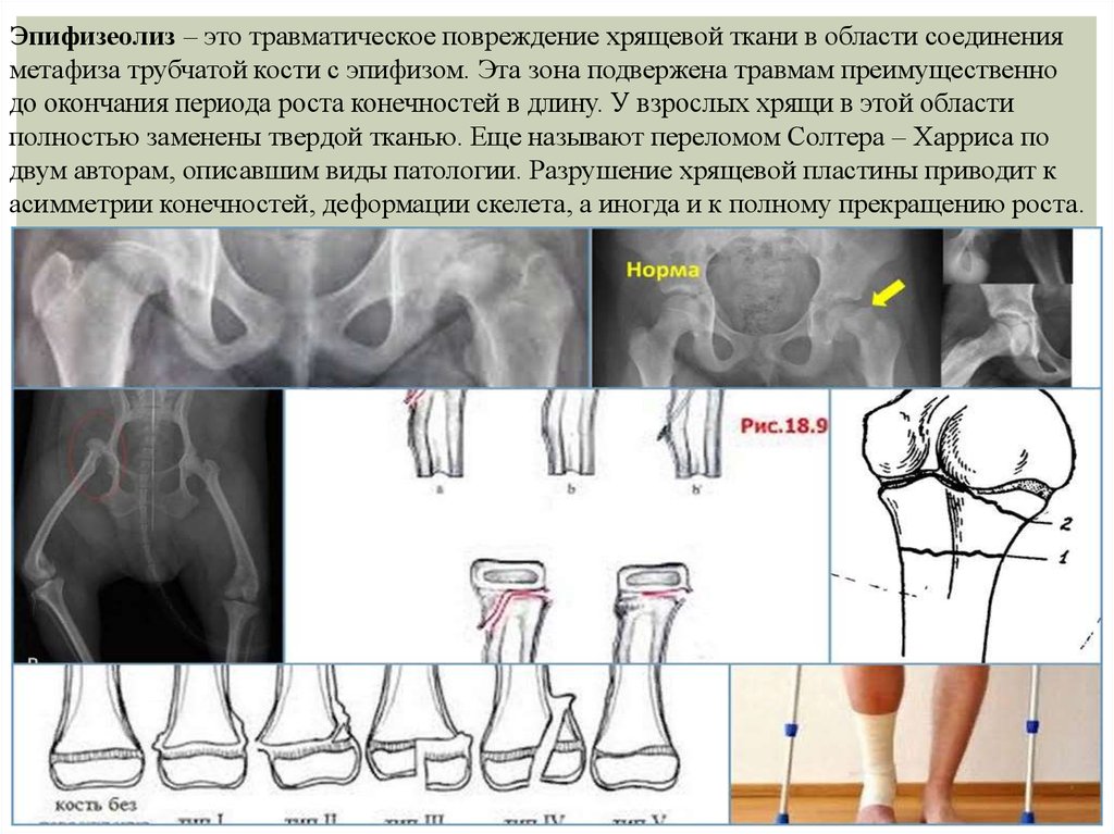 Эпифизеолиз. Эпифизеолиз большеберцовой кости рентген. Перелом голеностопа эпифизеолиз. Эпифизеолиз головки плечевой кости рентген. Эпифизеолиз дистального метаэпифиза большеберцовой кости.