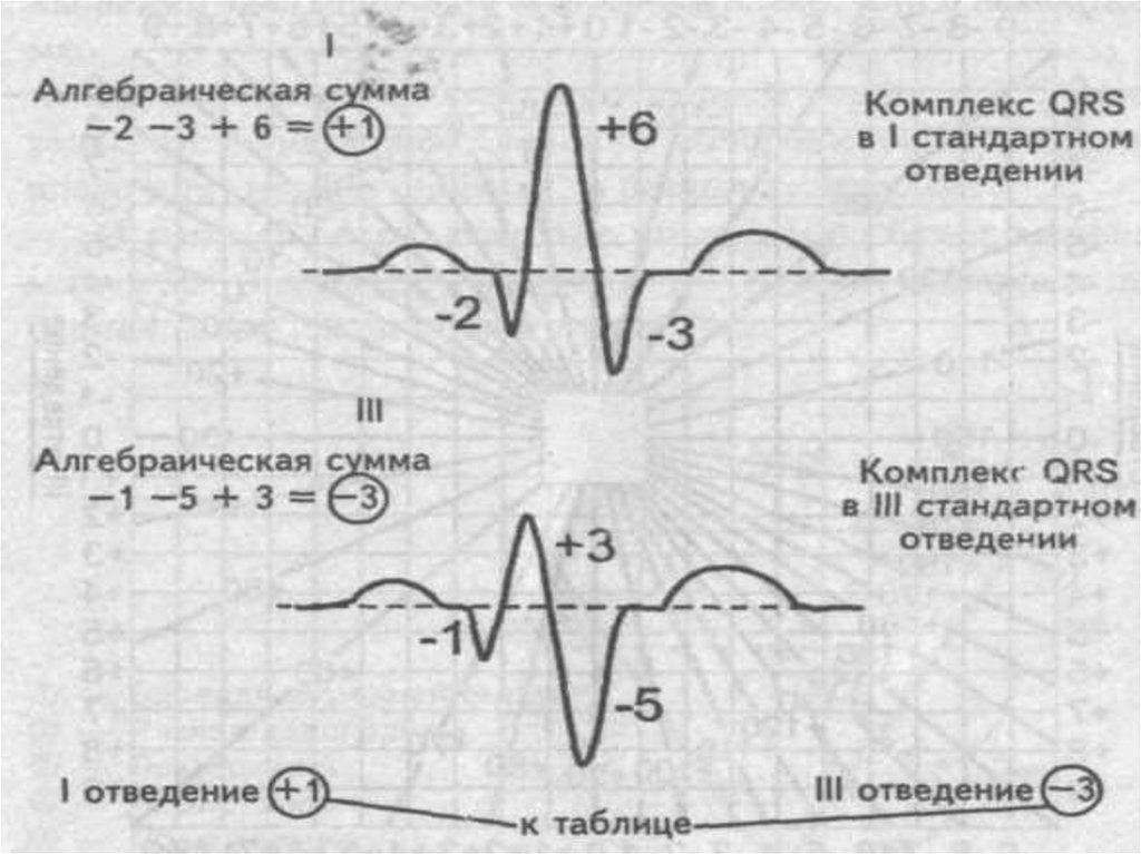 Эос экг. ЭОС на ЭКГ угол Альфа. Определение угла ЭКГ. Таблица Дьеда ЭКГ. Вычисление степени отклонения электрической оси сердца.