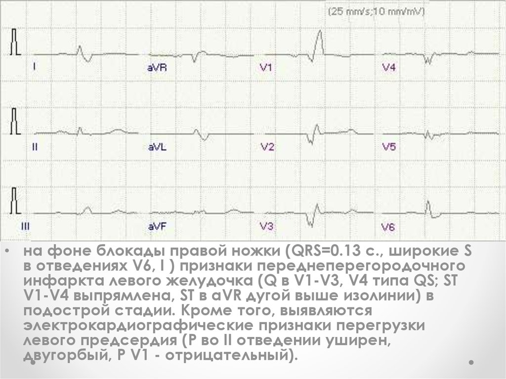 Перегородочный инфаркт экг. Переднеперегородочный инфаркт на ЭКГ. Переднеперегородочный инфаркт миокарда на ЭКГ. ЭКГ при переднеперегородочном инфаркте. Двугорбый QRS на ЭКГ.