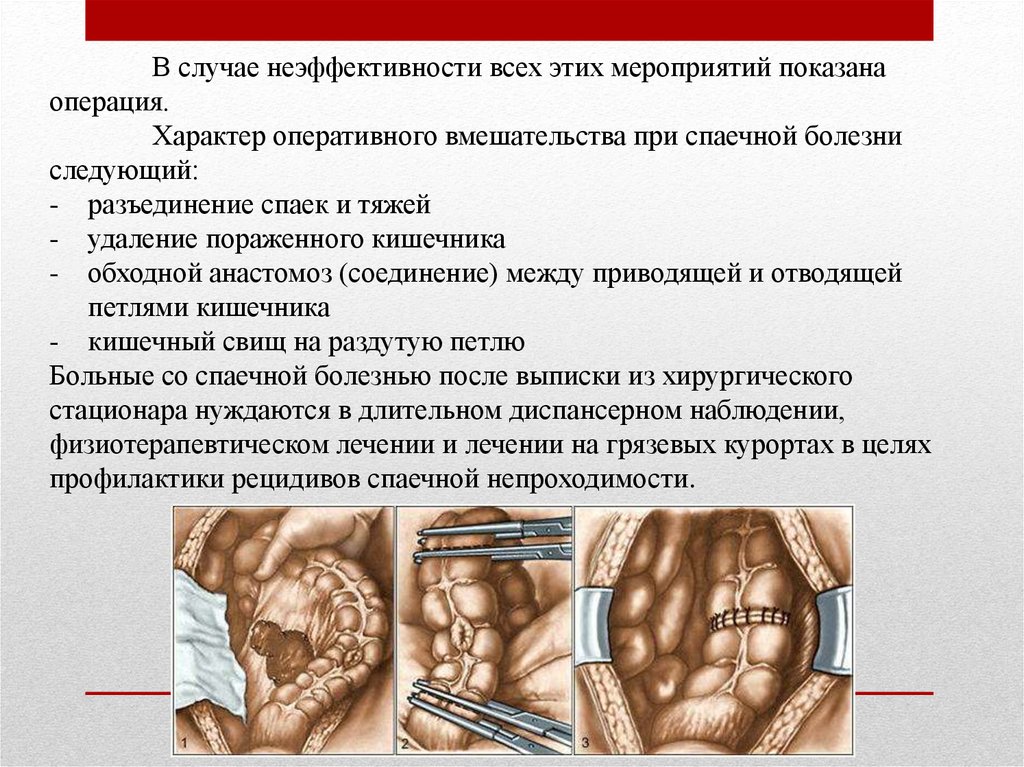 Диета при кишечной непроходимости у взрослых. Операция при спаечной болезни. Операции при спаечной болезни кишечника. Профилактика спаечной болезни в хирургии. Характер оперативного вмешательства.