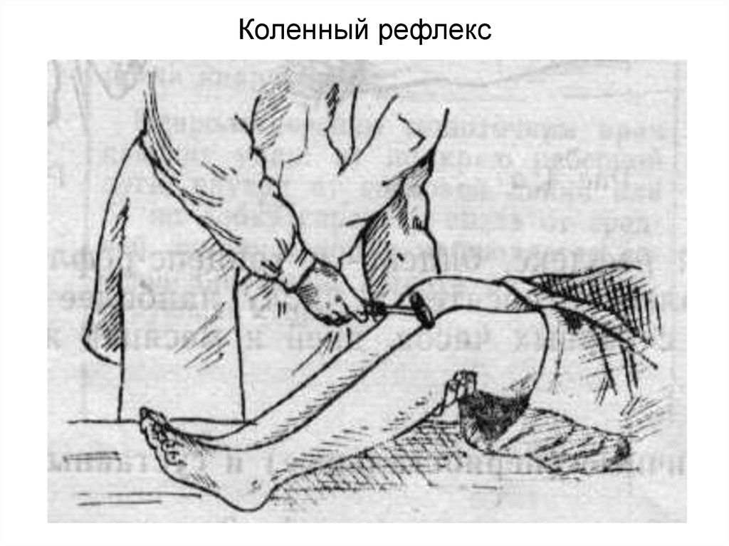 Коленный рефлекс. Рис 125 коленный рефлекс. Гиперрефлексия коленного рефлекса. Проверка рефлекса на коленях. Коленный рефлекс нога на ногу.