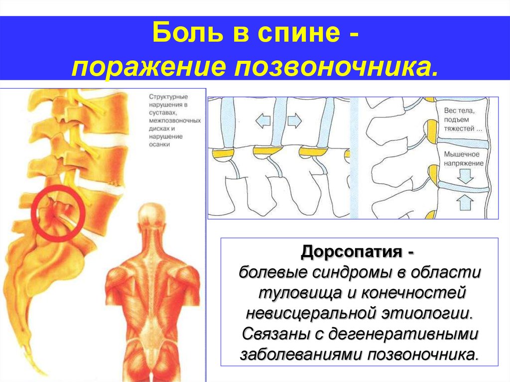 Дорсопатия поясничного отдела позвоночника. Дорсопатия позвоночника что это такое. Диагноз дорсопатия грудного отдела позвоночника. Дорсопатия поясничной локализации. Боли при дорсопатии.